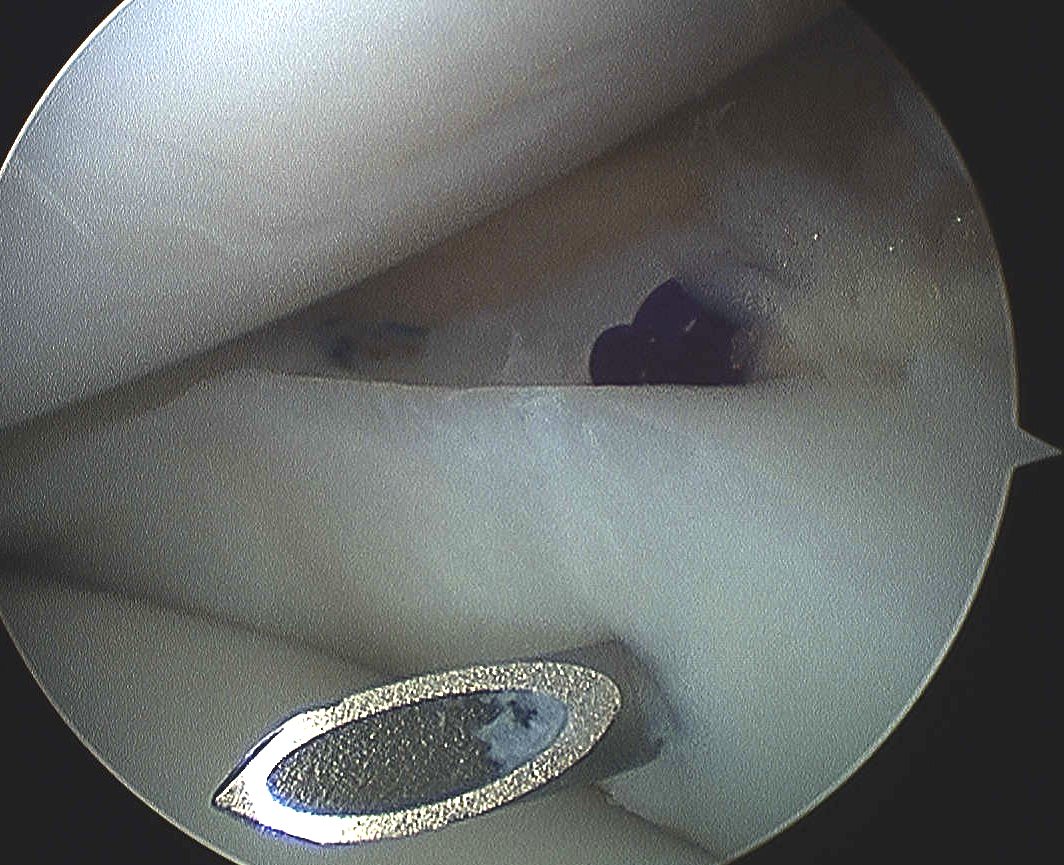 Anterior horn meniscal tear Repair 1